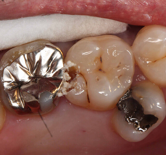 隠れ虫歯治療中の口腔内写真