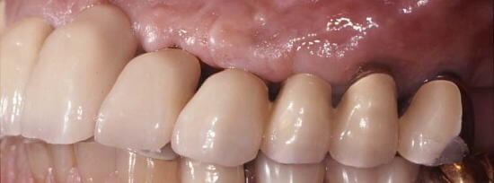 インプラント治療後6年経過した口腔内写真