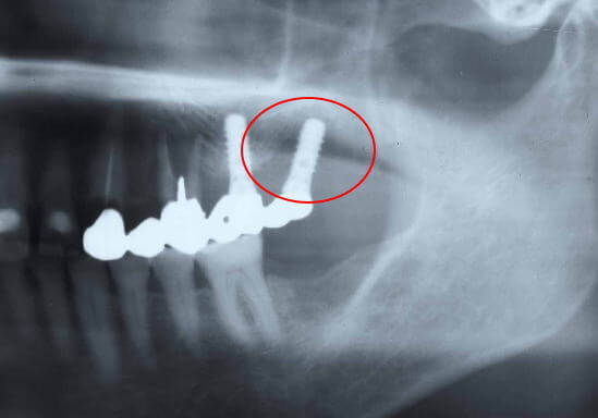 インプラント周囲の骨が溶かされているレントゲン写真