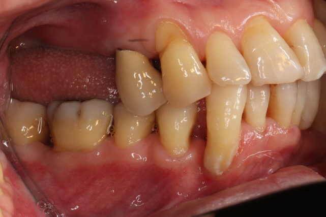 短縮歯列治療後の写真