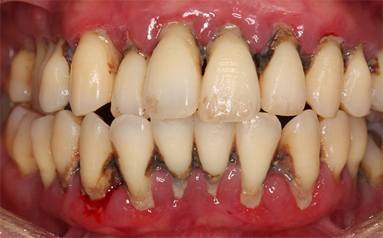 重症な歯周病患者さんの口腔内写真