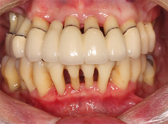 治療終了後7年経過した口腔内写真